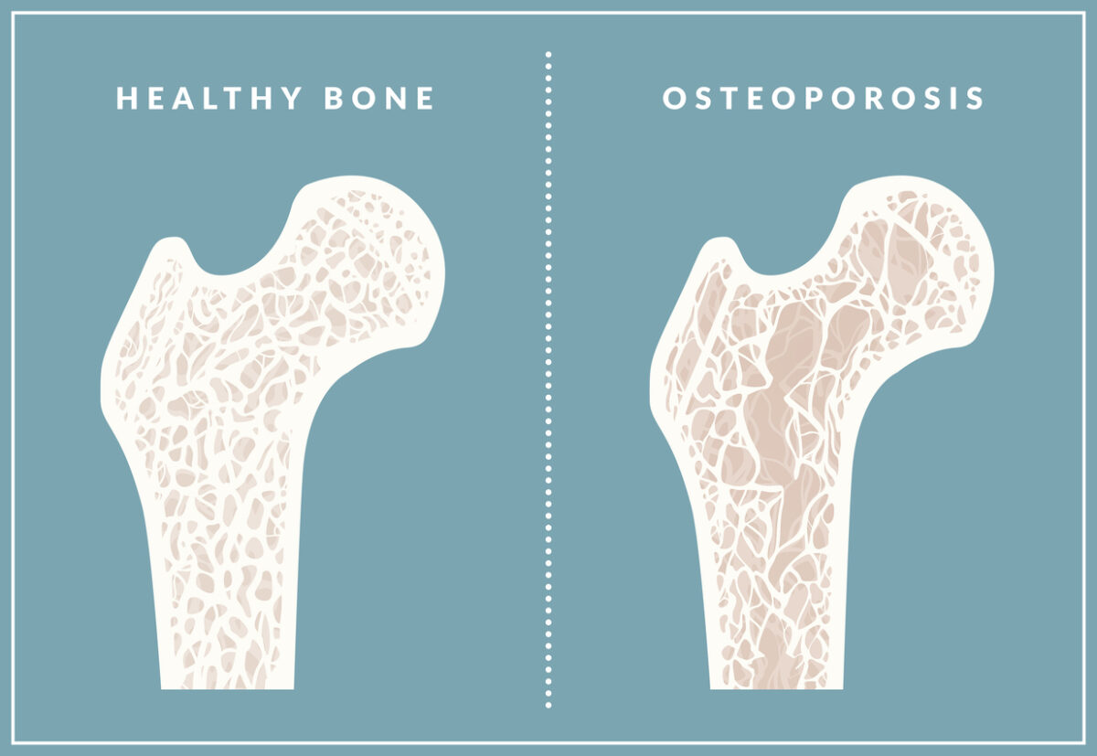 Healthy bone vs osteoporosis bone diagram