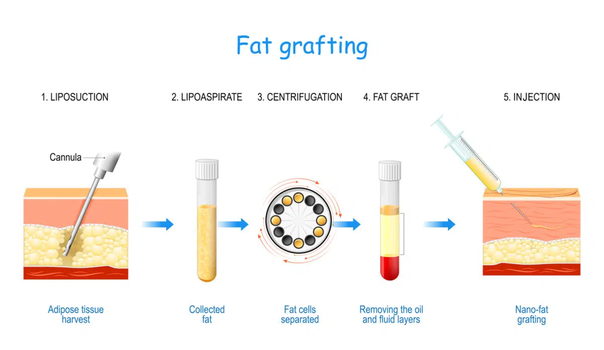Fat grafting