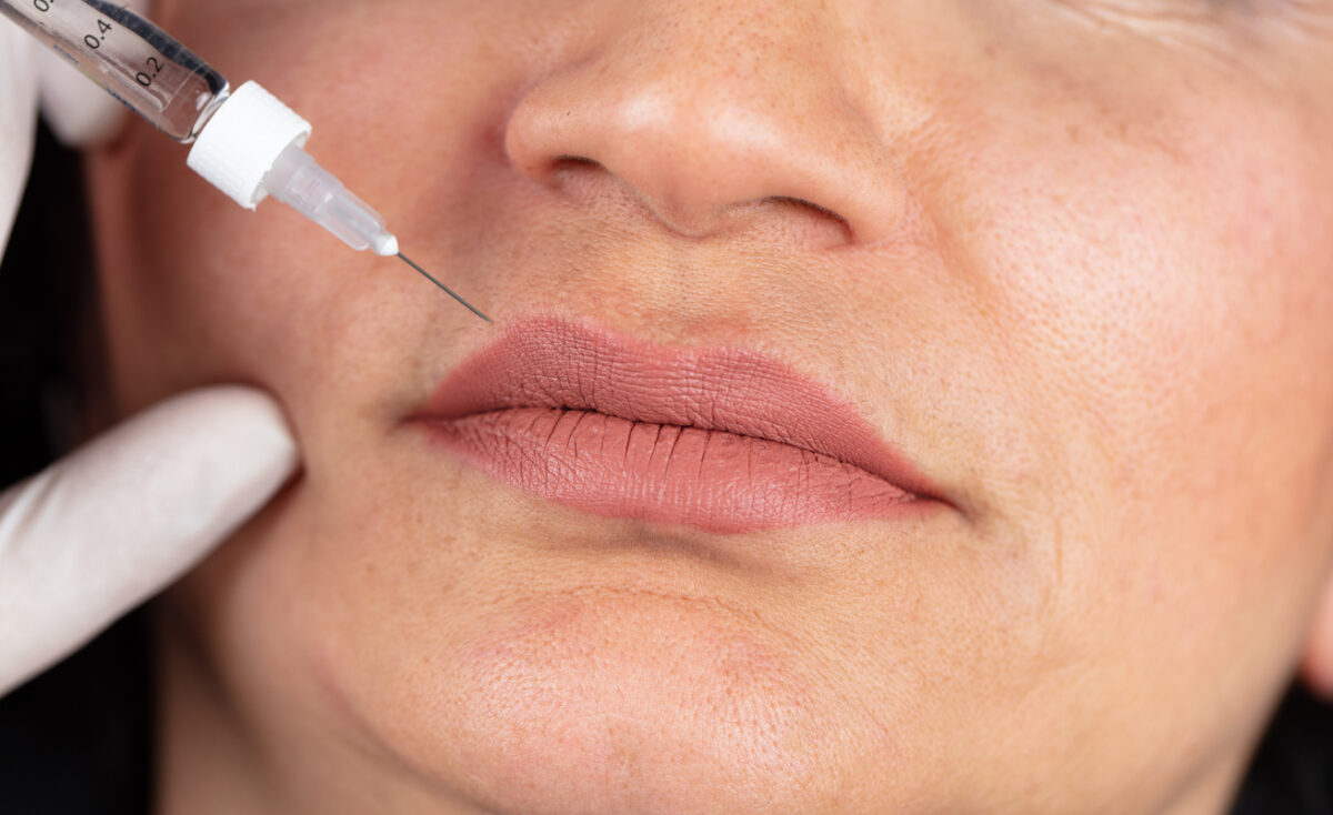 lip injection, lip flip