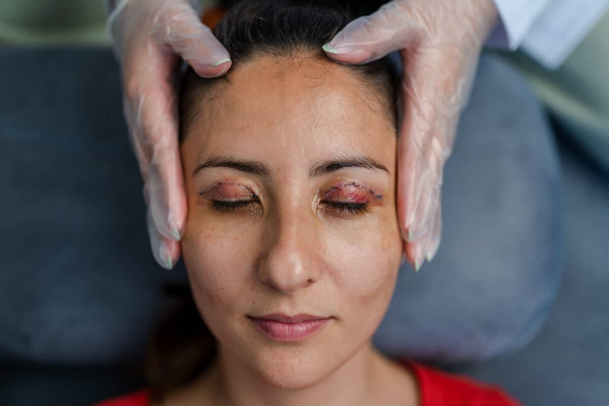 Upper-Eyelid Blepharoplasty