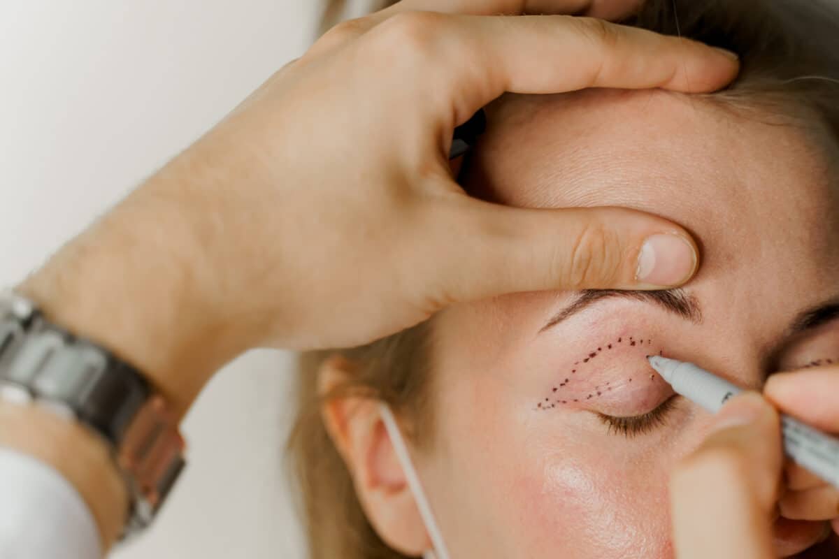 Blepharoplasty markup