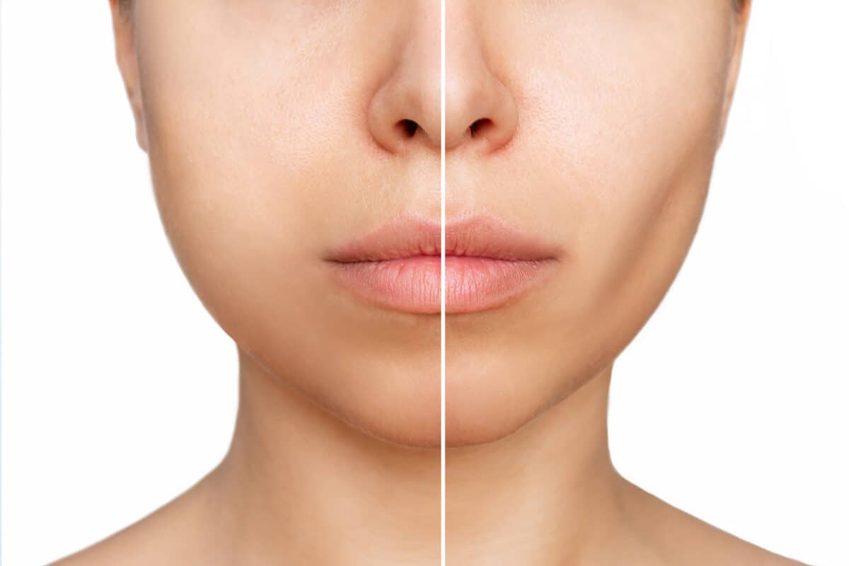 Buccal fat before and after