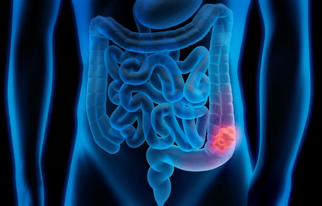 Colonoscopies, especially after 50, are important for early detection of colon cancer.