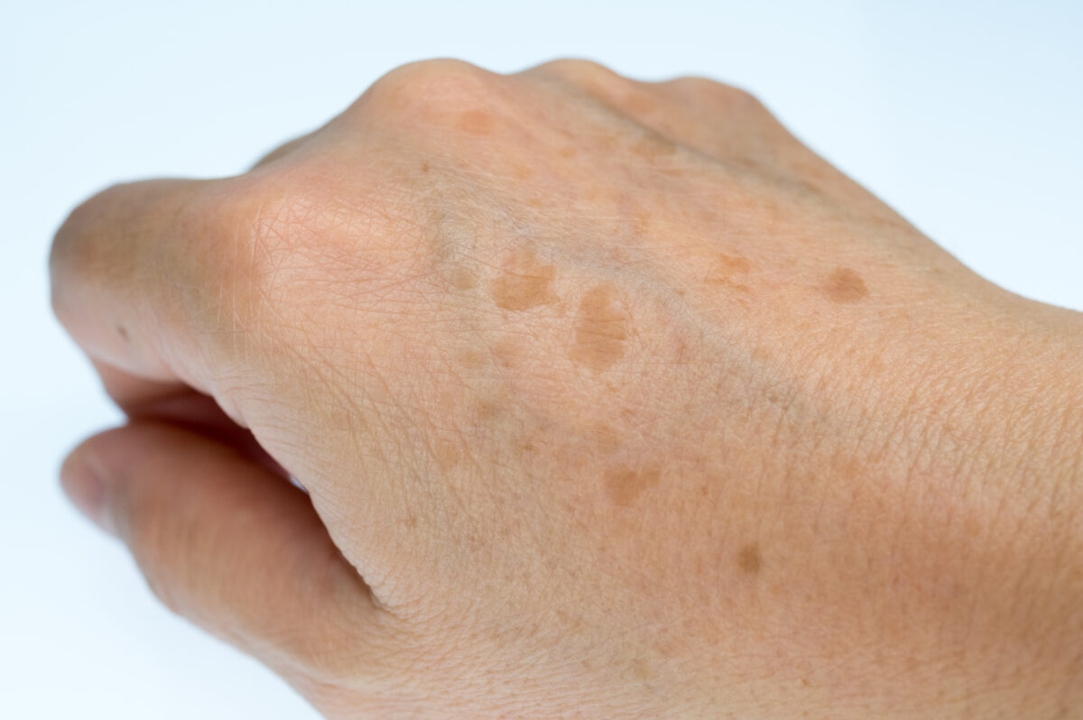 Hands of a woman suffering from age spots