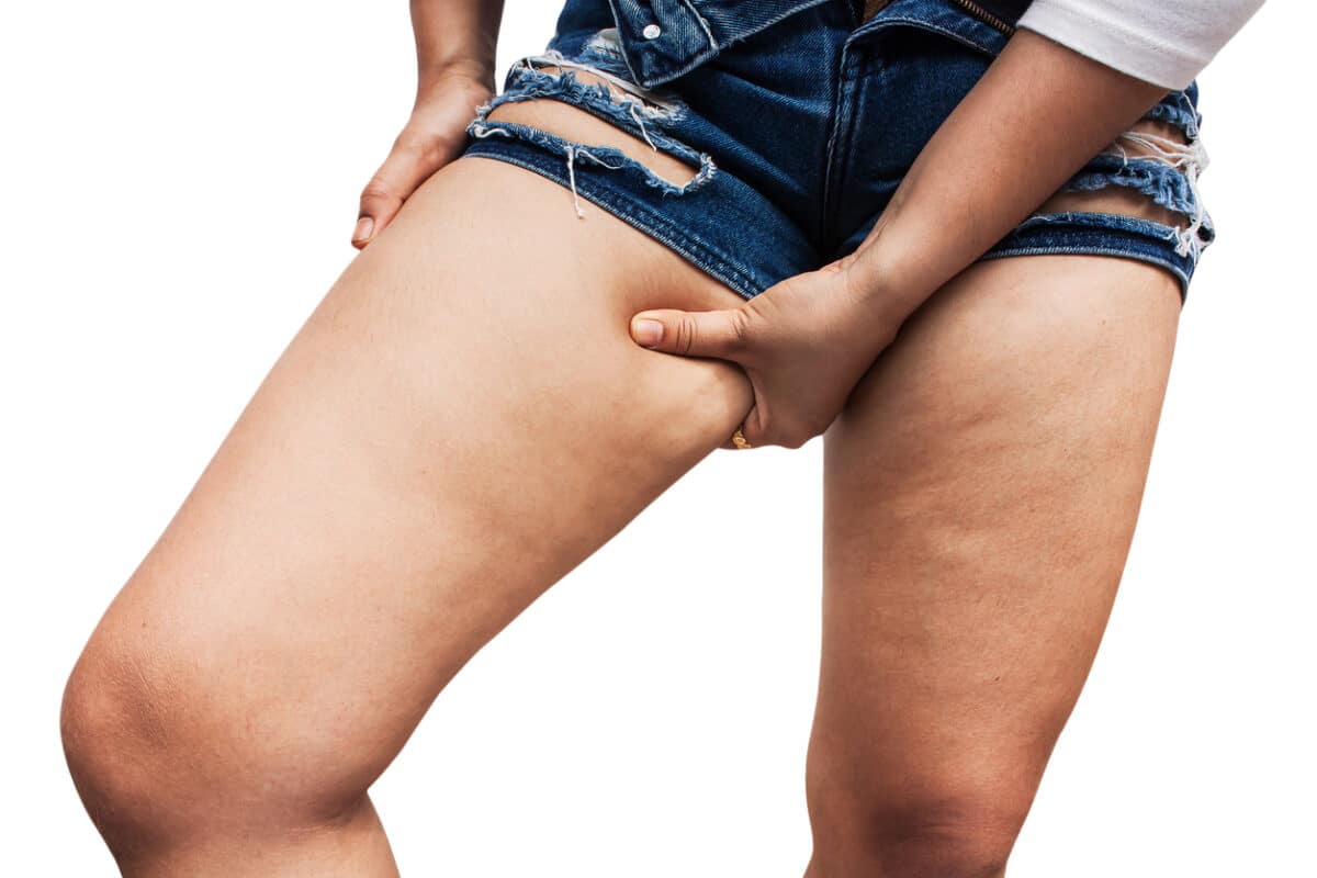 Fat thighs, cellulite