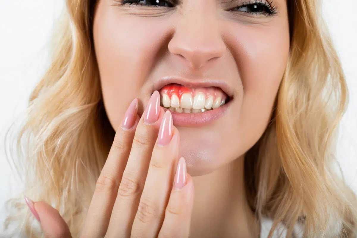 vitamin c deficiency or toothache or gum disease