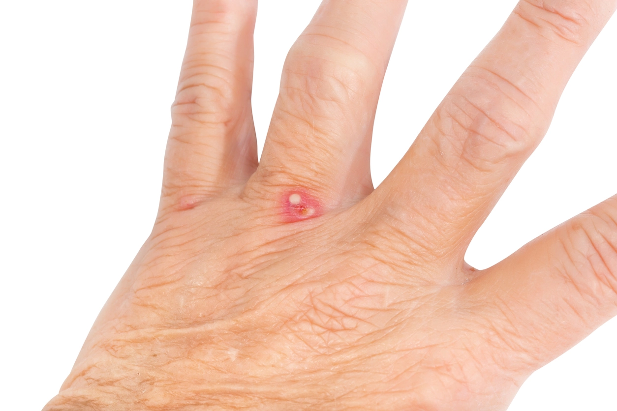 Red Ant Bite 