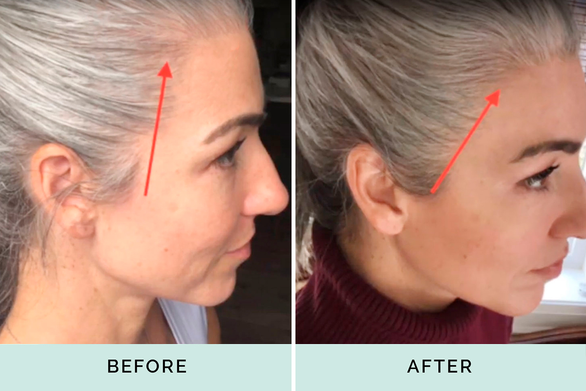 Kera Health before and after thinning hair line 