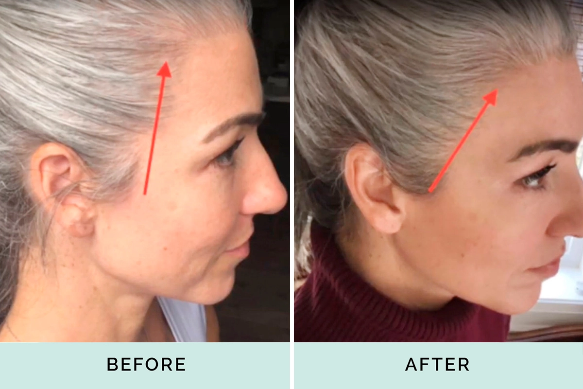 Kera Health before and after thinning hair line 