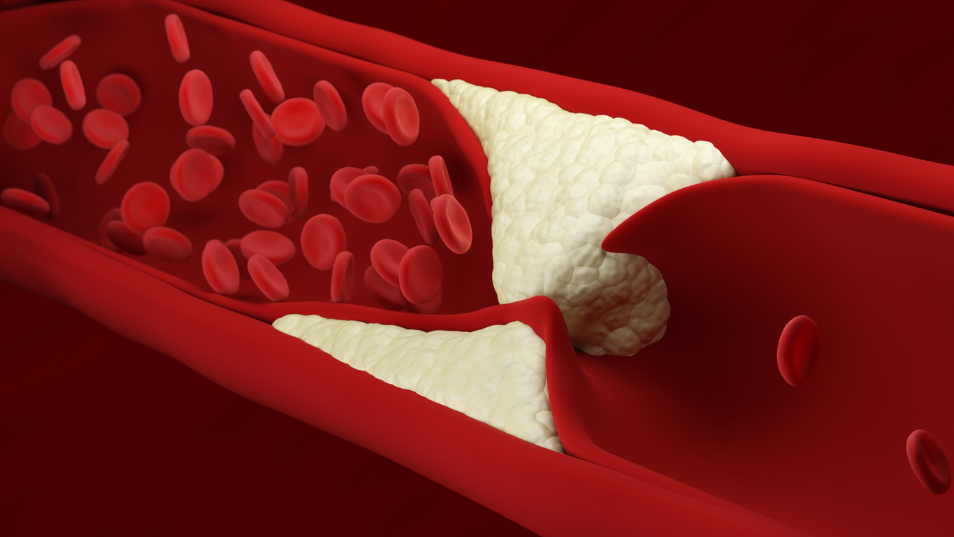 Cholesterol build-up can cause arteries to narrow