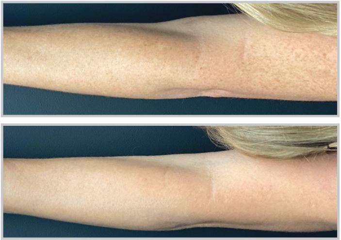 BBL Hero for broadband laser skincare