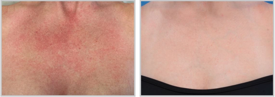 BBL HERO chest before and after treatment