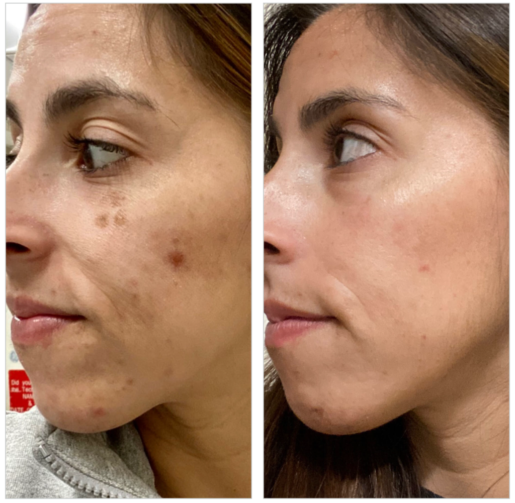 BBL HERO visage avant et après traitement