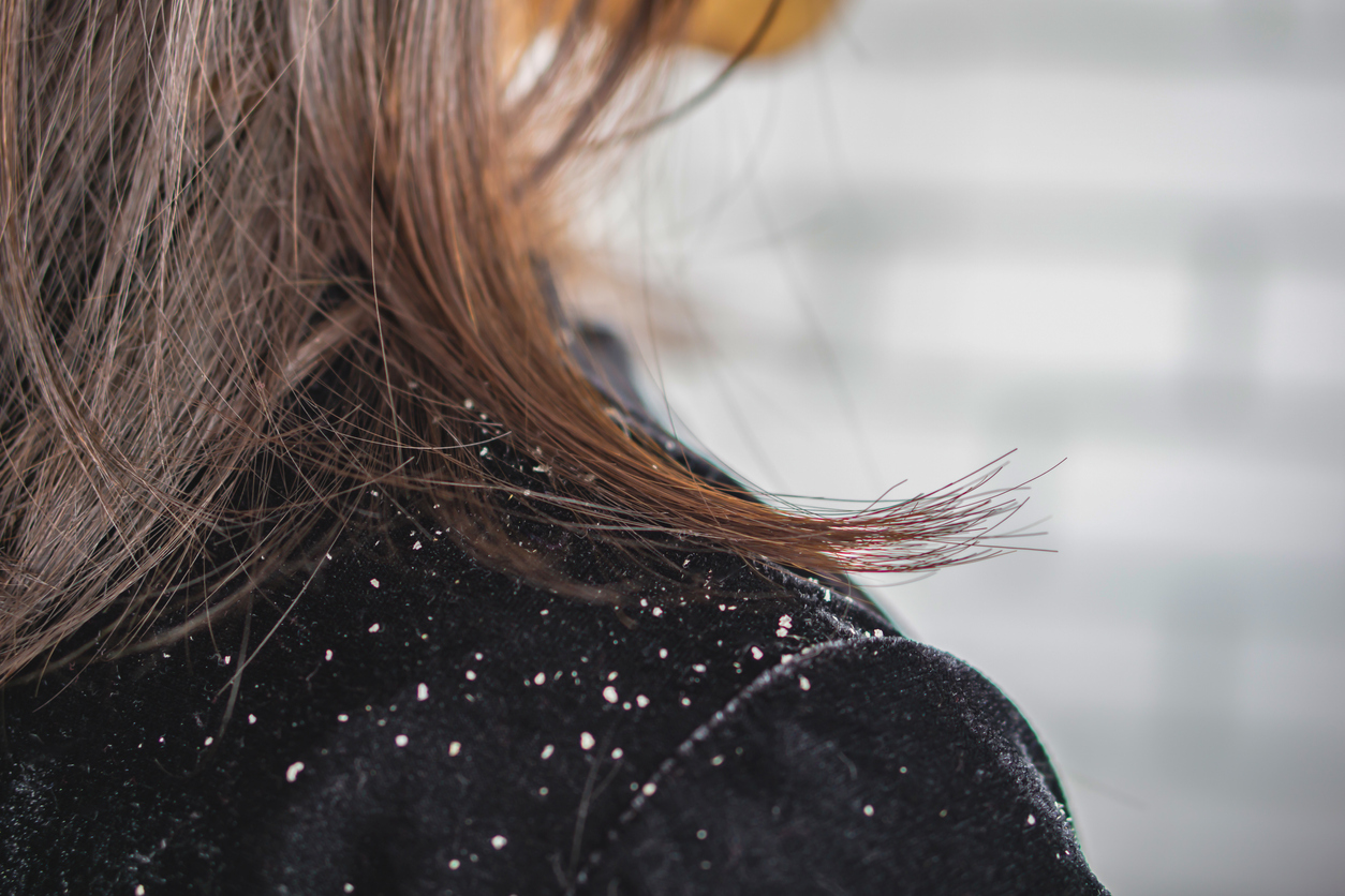 Dandruff on a shoulder from a dry, itchy scalp