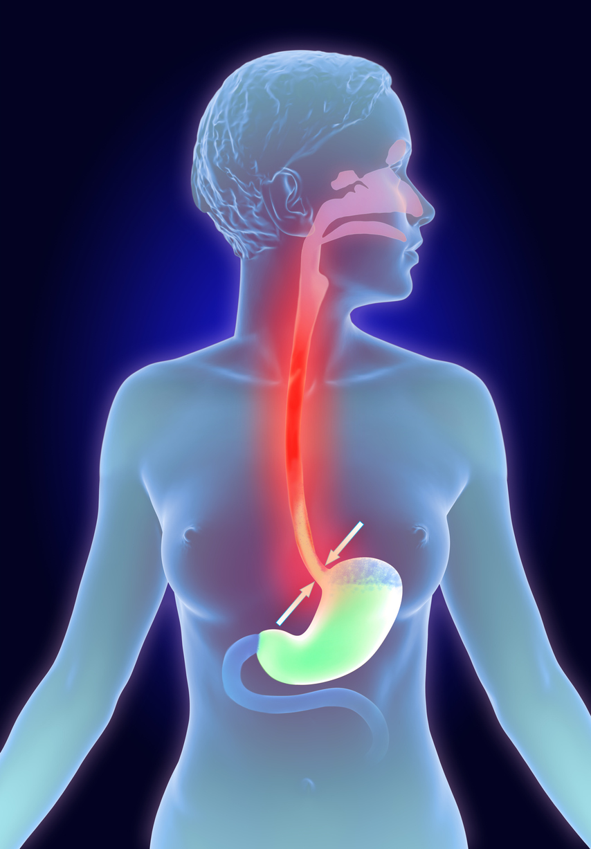 Acid reflux vs peptic ulcers