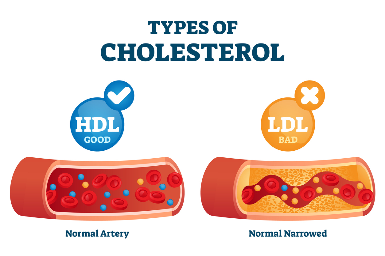 Types of cholesterol HDL vs LDL