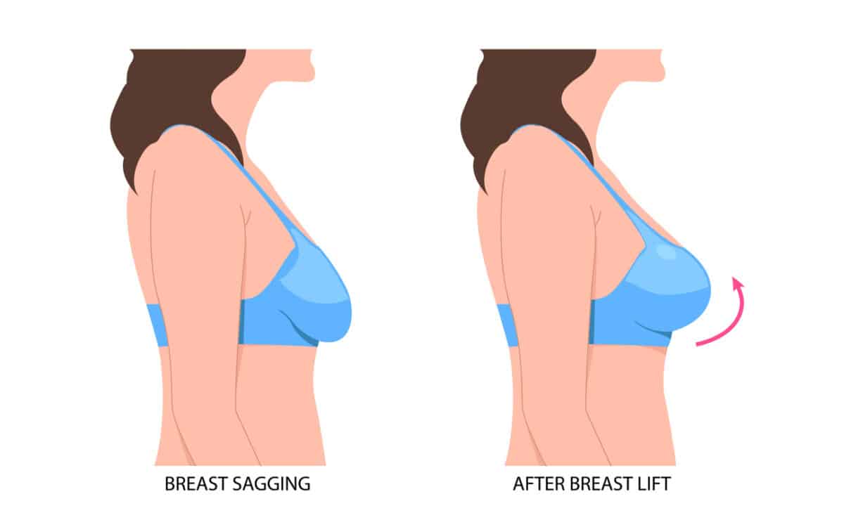 Breast lift before and after graphic