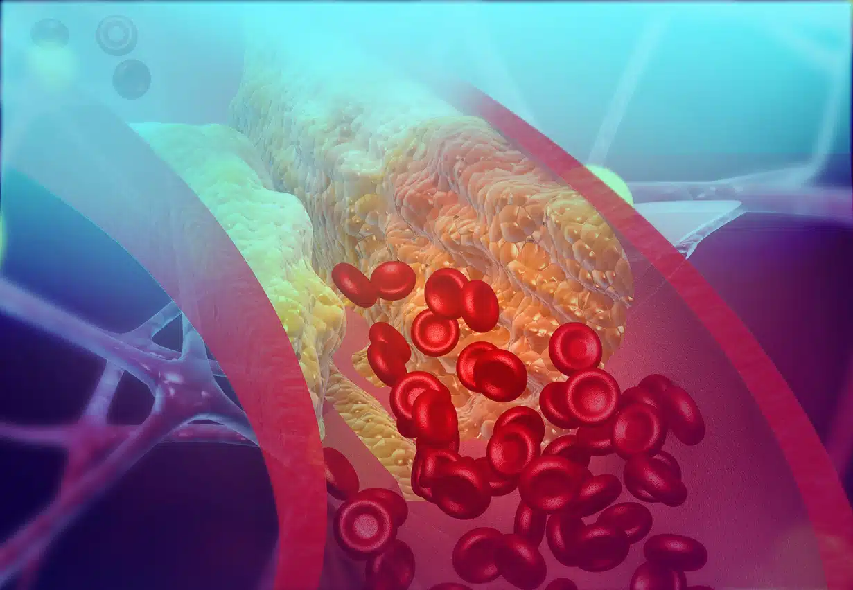 Blood flow to heart blocked causing a heart attack or chest pain; cholesterol