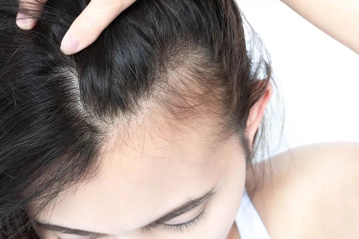Hair thinning or hair loss around face