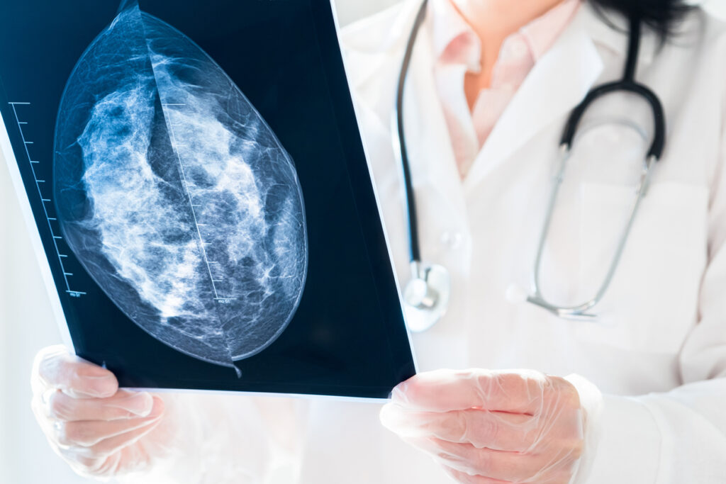 Mammogram Markers - radiologist looking at mammography results on x-ray.