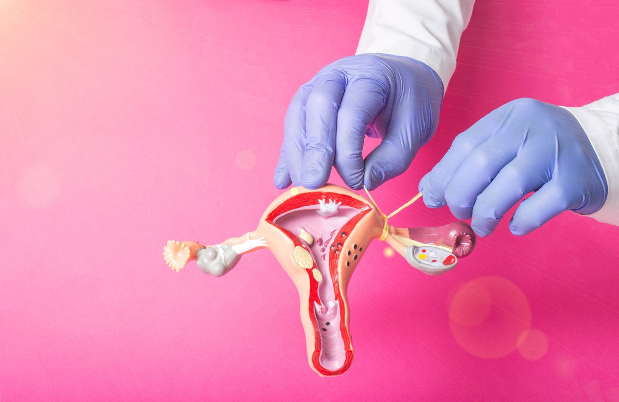 Tubal ligation or getting your tubes tied