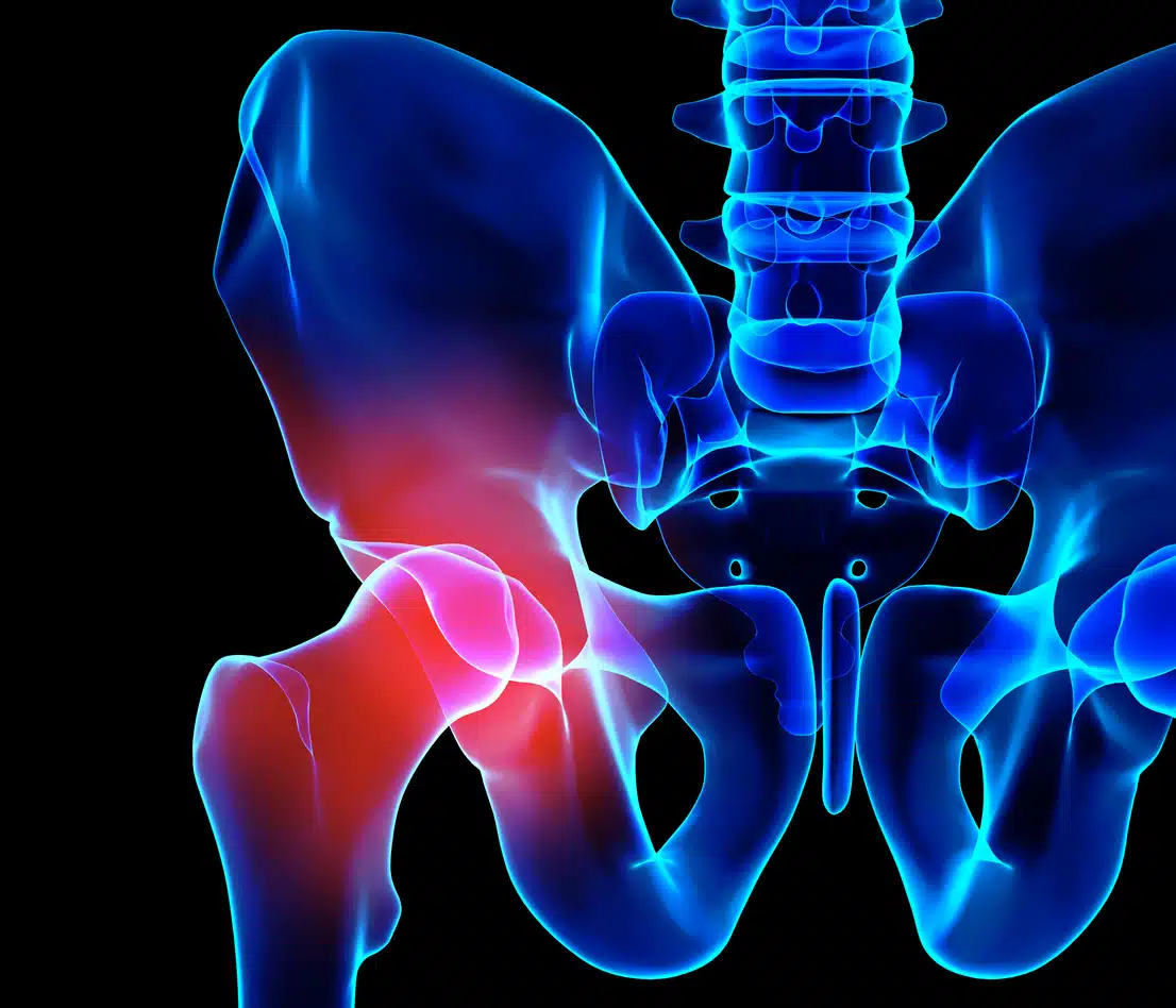 Image of pain in the hip bone