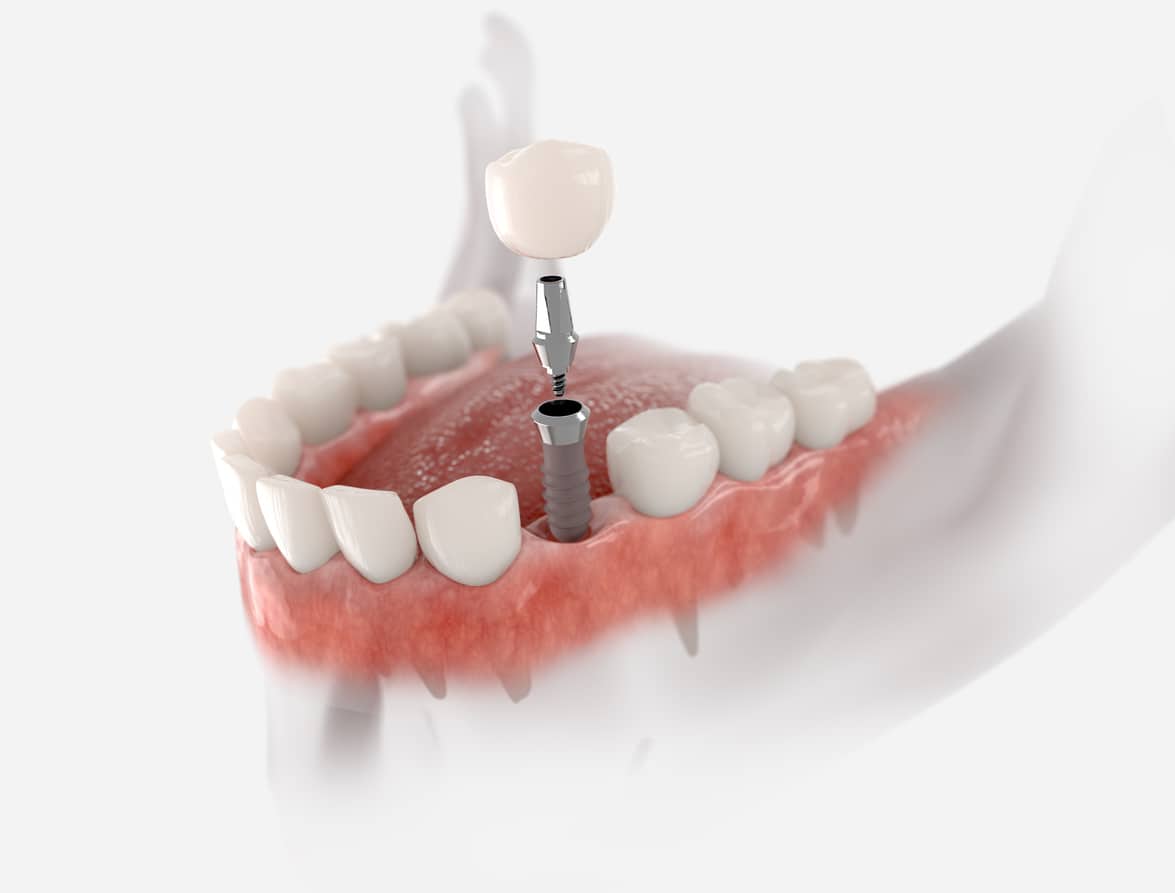 Premolar tooth implant