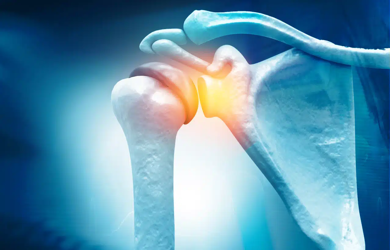 Shoulder pain in the rotator cuff