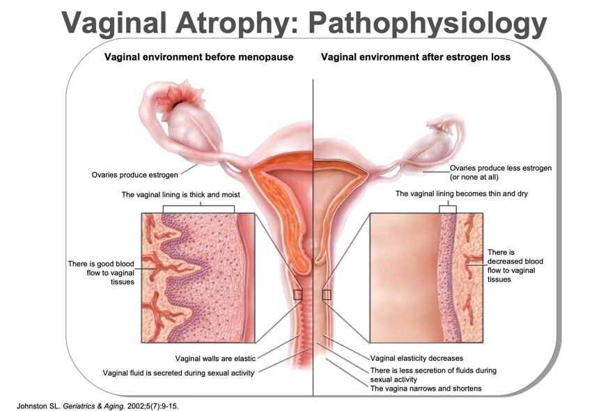 Vaginal Atrophy Image