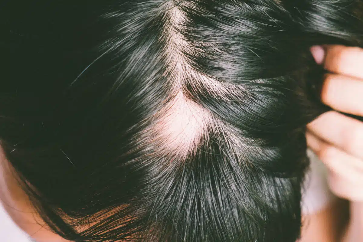 Alopecia spot balding
