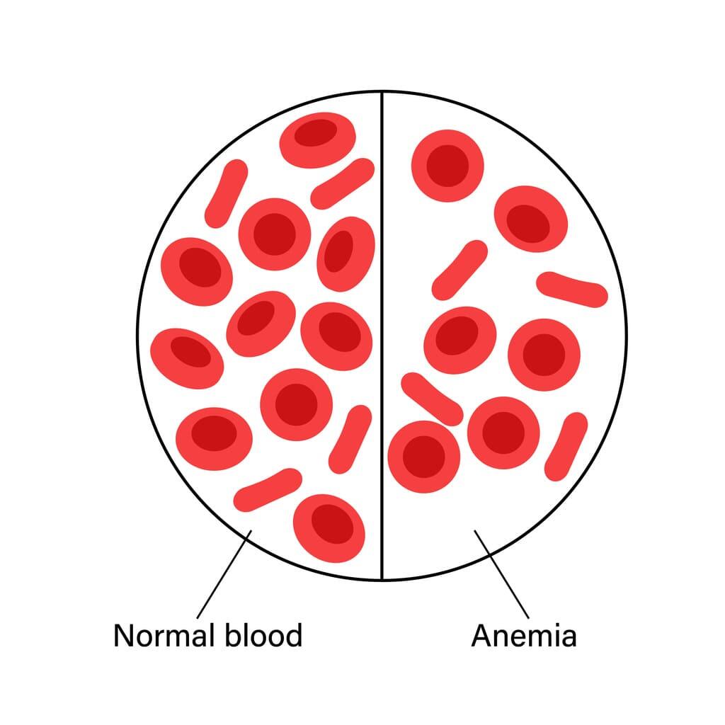 Normal blood vs. anemia