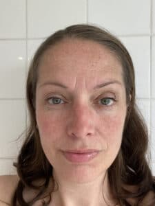 Close up of hyperpigmentation on face