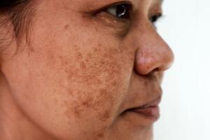Hyperpigmentation Melasma