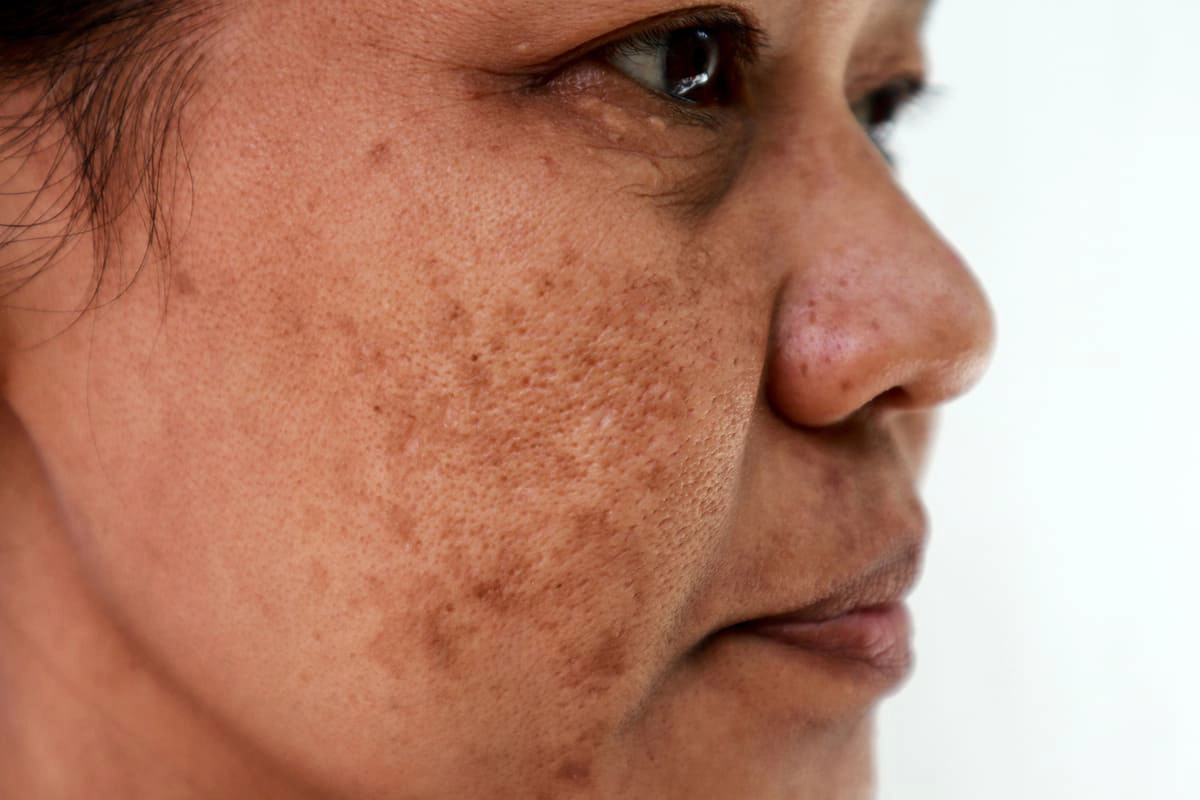 Hyperpigmentation Melasma