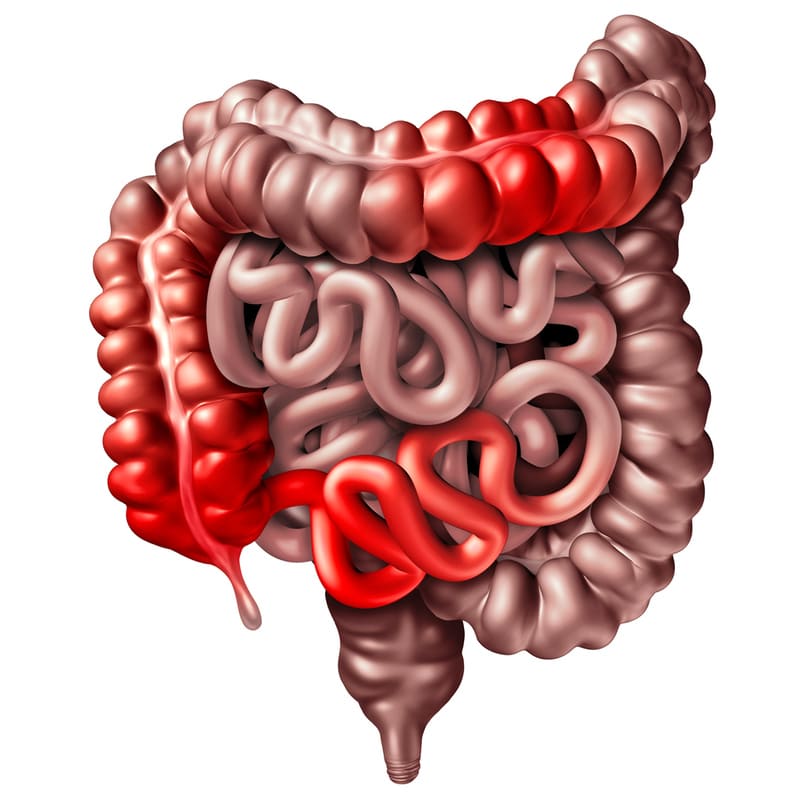 Intestine graphic for Crohn's Disease (1)