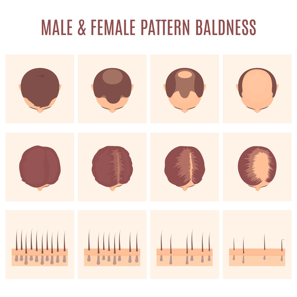 Male and female pattern baldness or alopecia