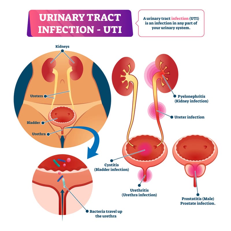Image of a UTI and the internal workings that are affected