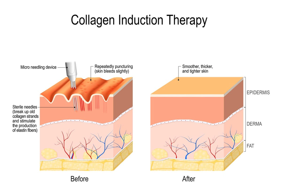 Collagen induction therapy