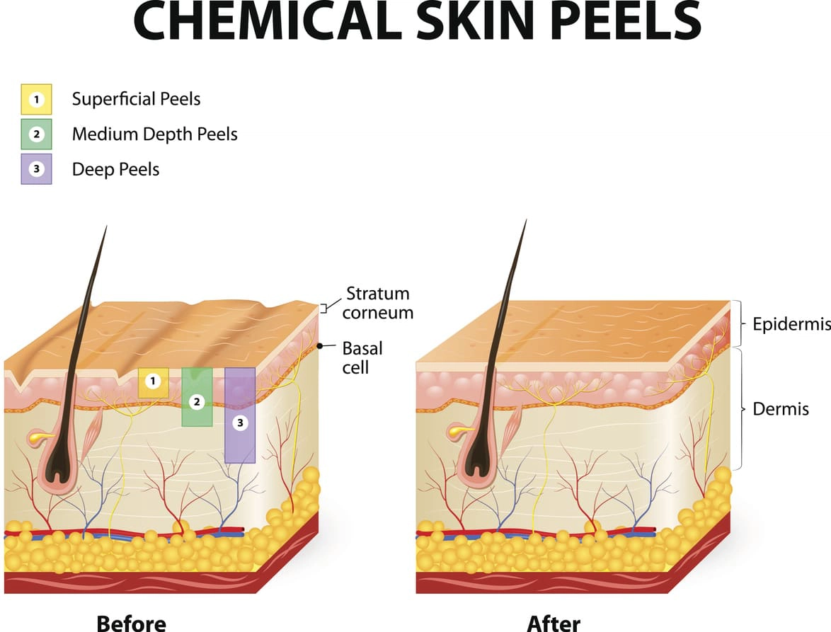 Image of a chemical peel