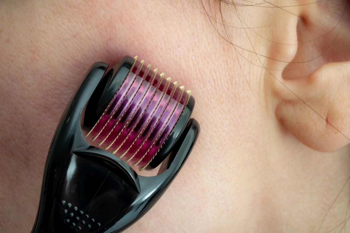 Microneedling close up image