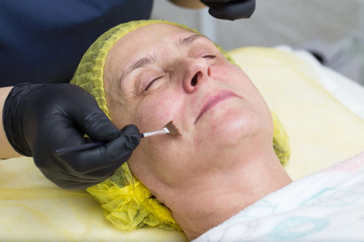 Woman getting a chemical peel