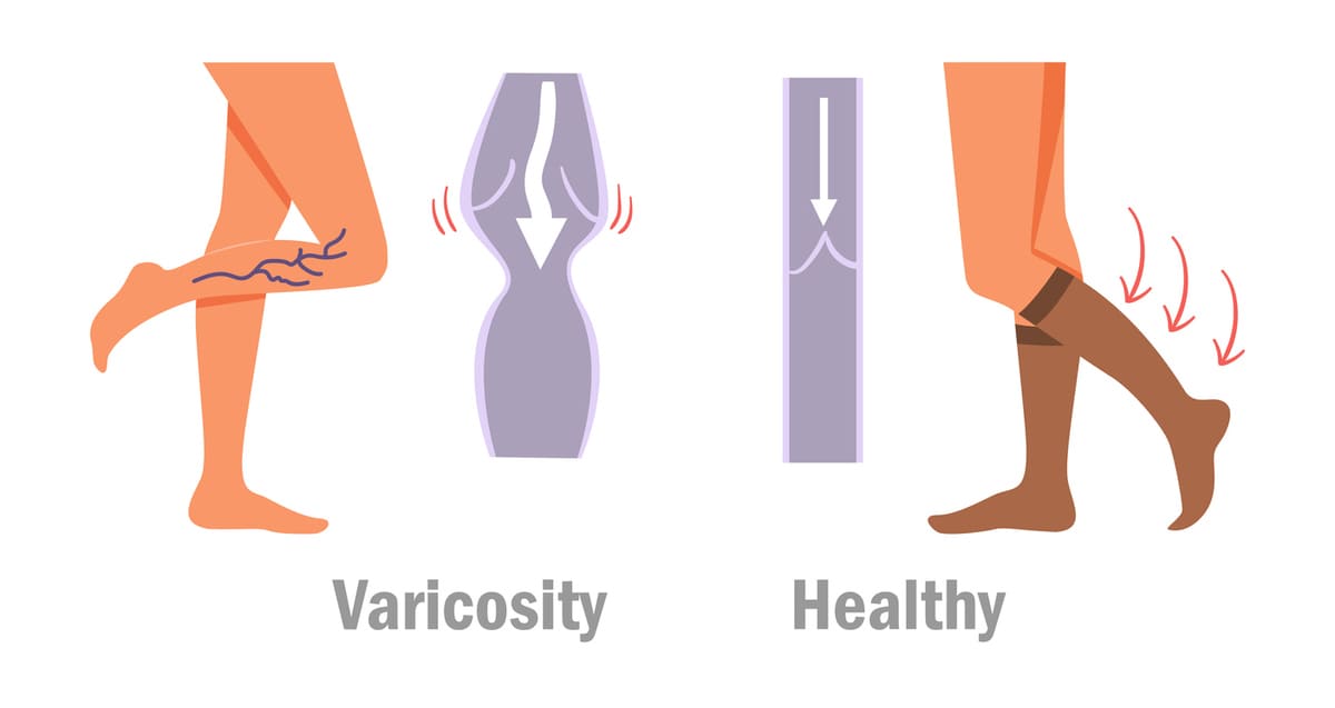 Compression socks for varicose veins illustration