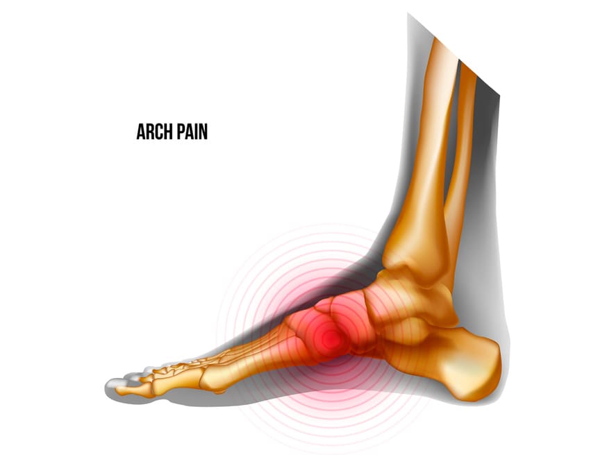 arch pain image