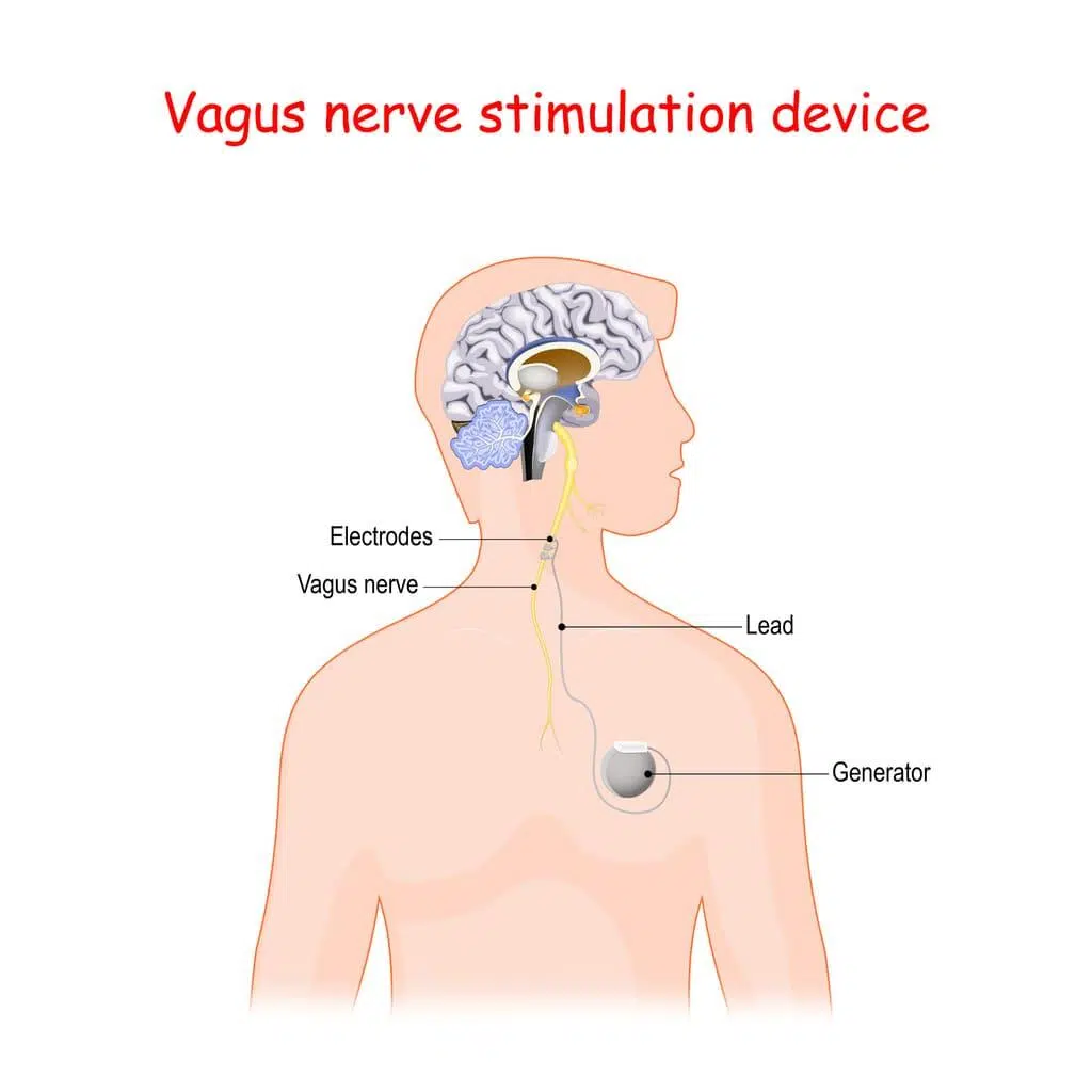 vagus nerve stimulation