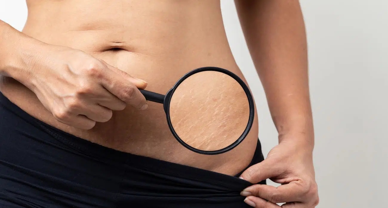 Stretch marks