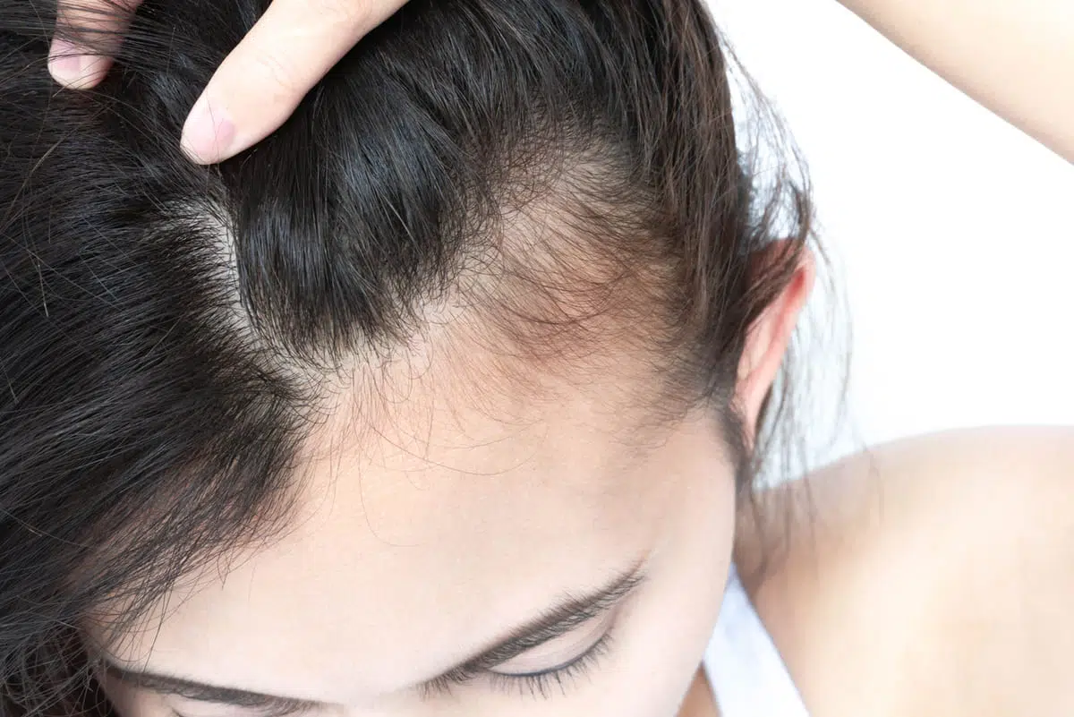 Thinning hair