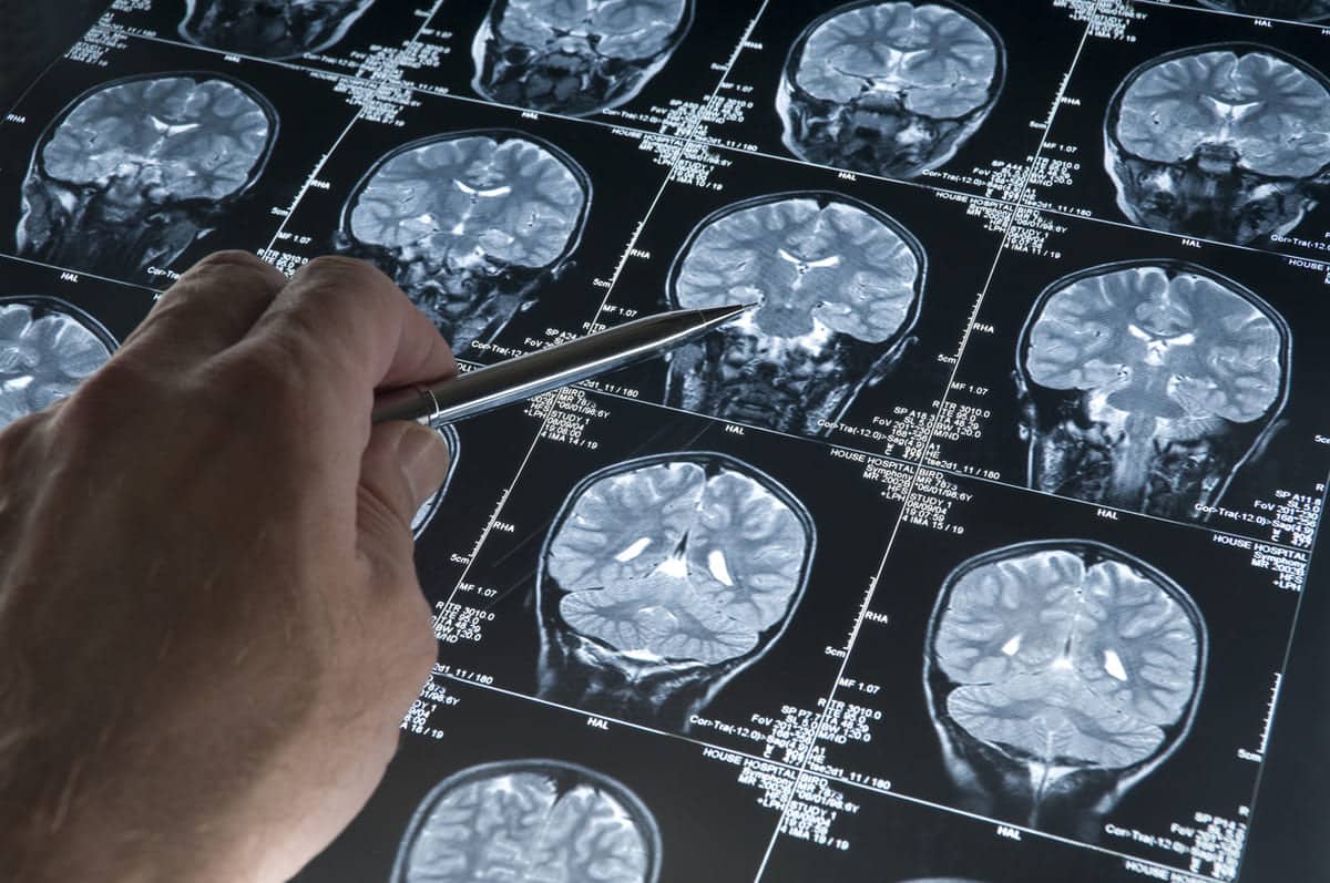 Cognitive decline