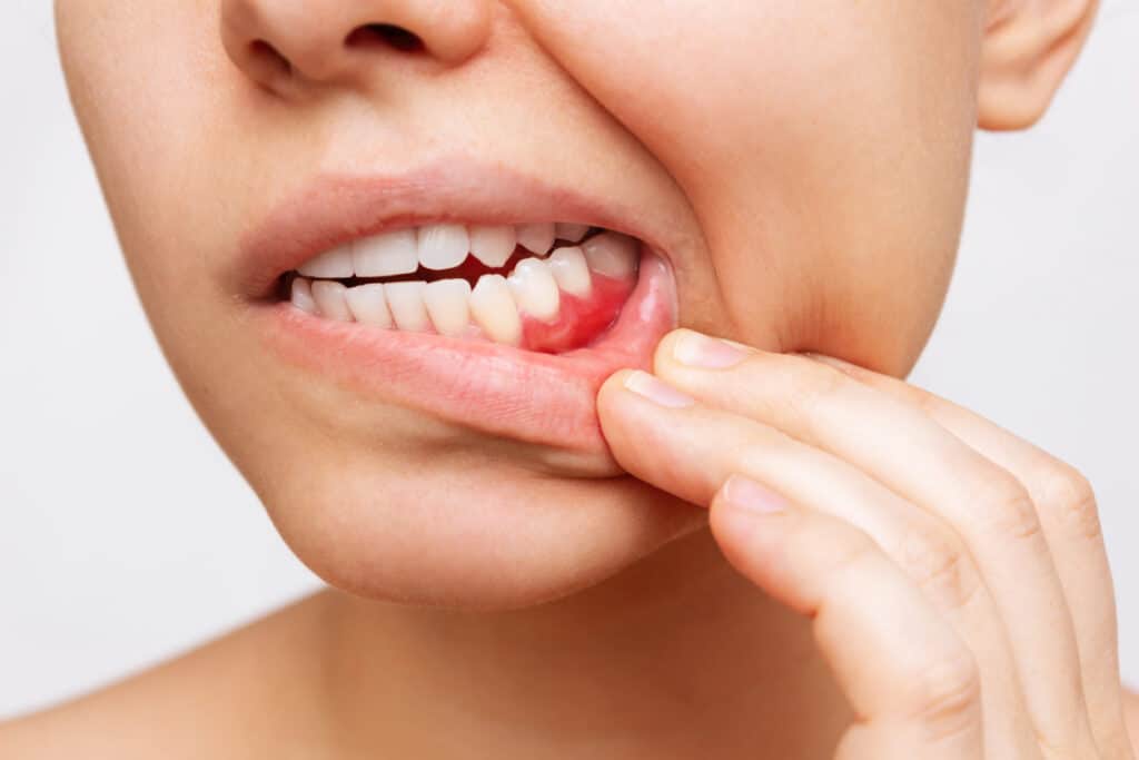 What herbs help inflamed gums?
