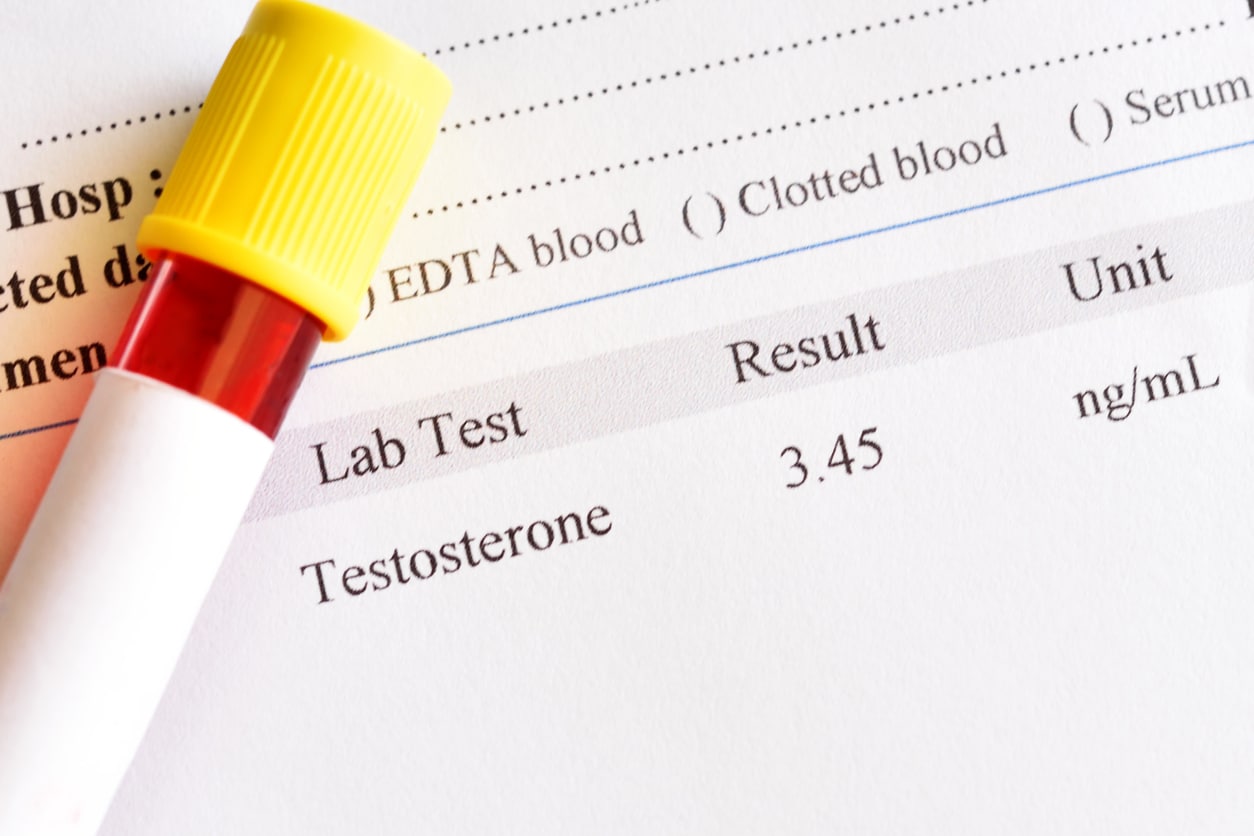 Blood sample with testosterone hormone result