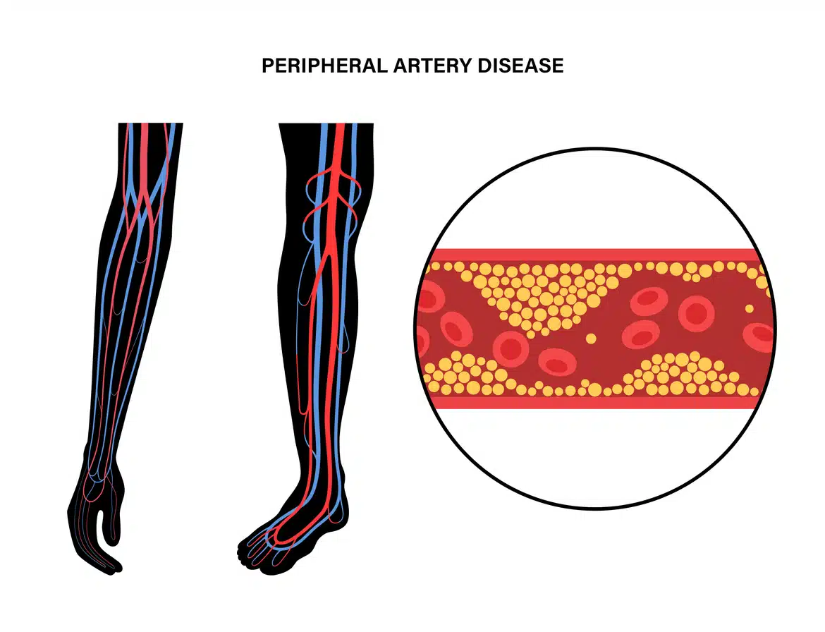 Peripheral Artery Disease